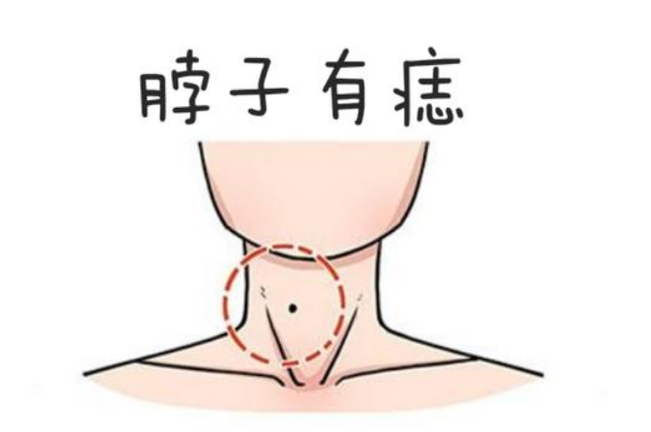 脖子上的痣图解大全,《脖子上的痣：面相学中的意义和解读》